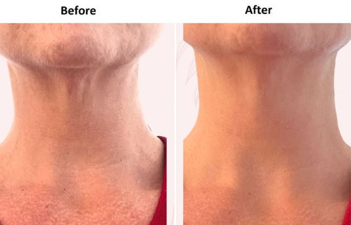 Face and Neck Lift Before & After