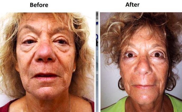 Face and Neck Lift Before & After