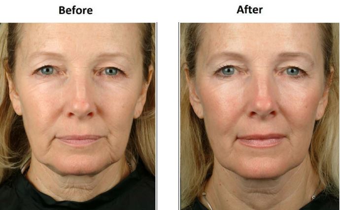 Face and Neck Lift Before & After