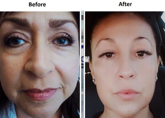 Face and Neck Lift Before & After