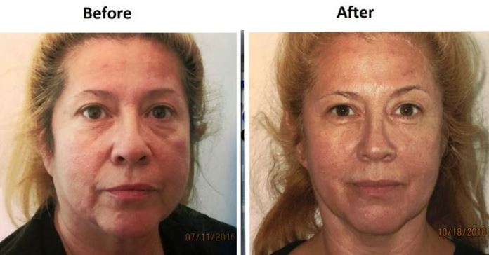 Face and Neck Lift Before & After