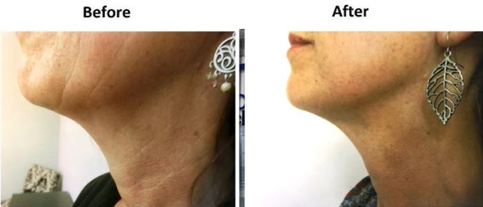 Face and Neck Lift Before & After