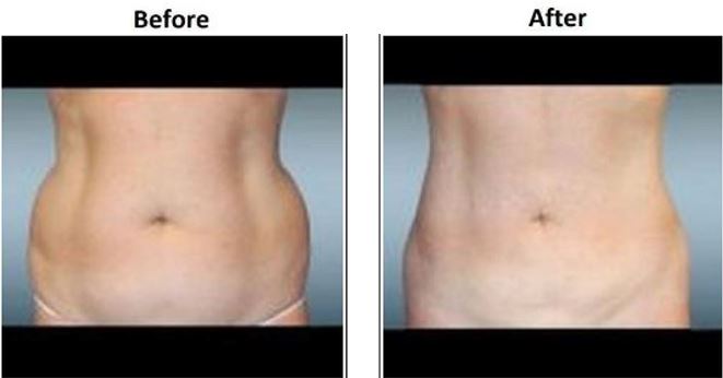 Female Love Handles Sculpting Before and After