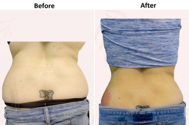 Female Love Handles Sculpting Before and After