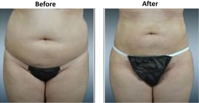 Female Love Handles Sculpting Before and After